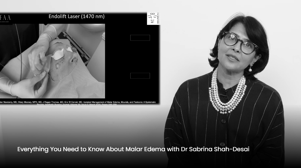 Everything You Need to Know About Malar Edema with Dr Sabrina Shah-Desai